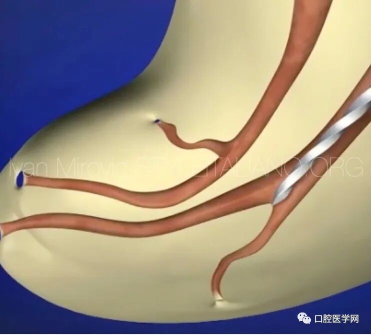 牙医帮-【经验分享】深部根尖分叉的处理