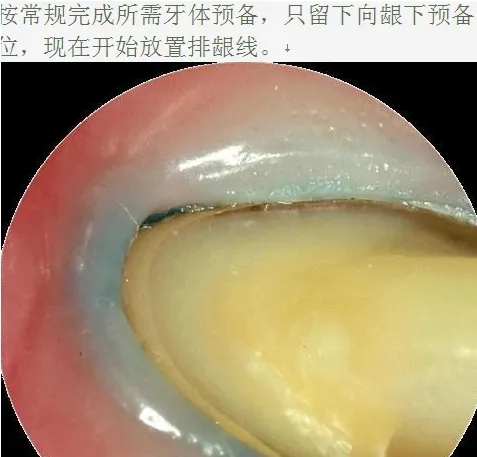牙医帮-口腔临床排龈,你需要掌握这个技巧