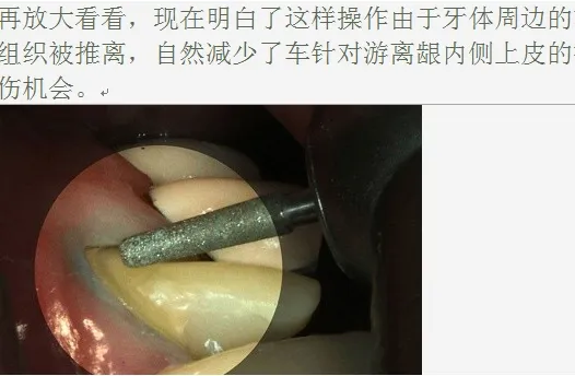 牙医帮-口腔临床排龈,你需要掌握这个技巧