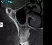 牙医帮-各种形态的上颌窦及内提要领